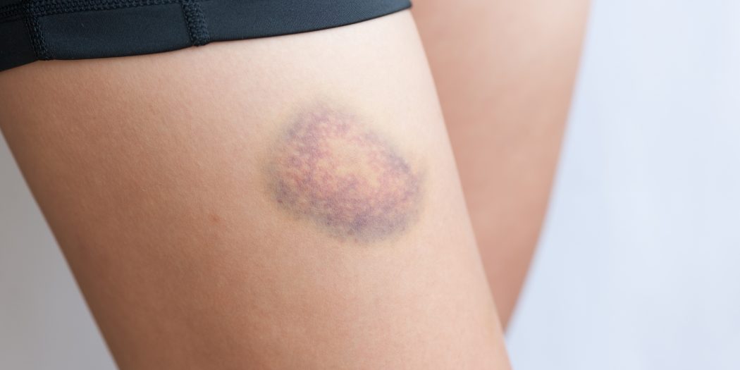 krwiak siniak na nodze