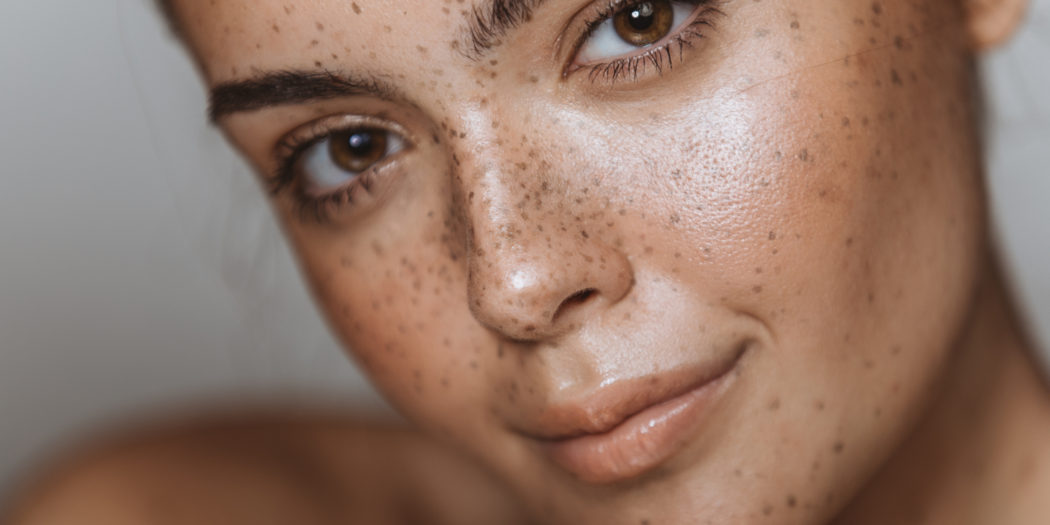 Kobieta z melasmą - brązowymi plamkami na twarzy