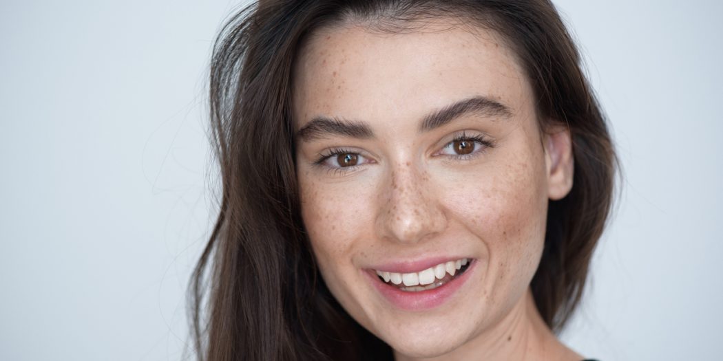 piękna brunetka z przebarwieniami