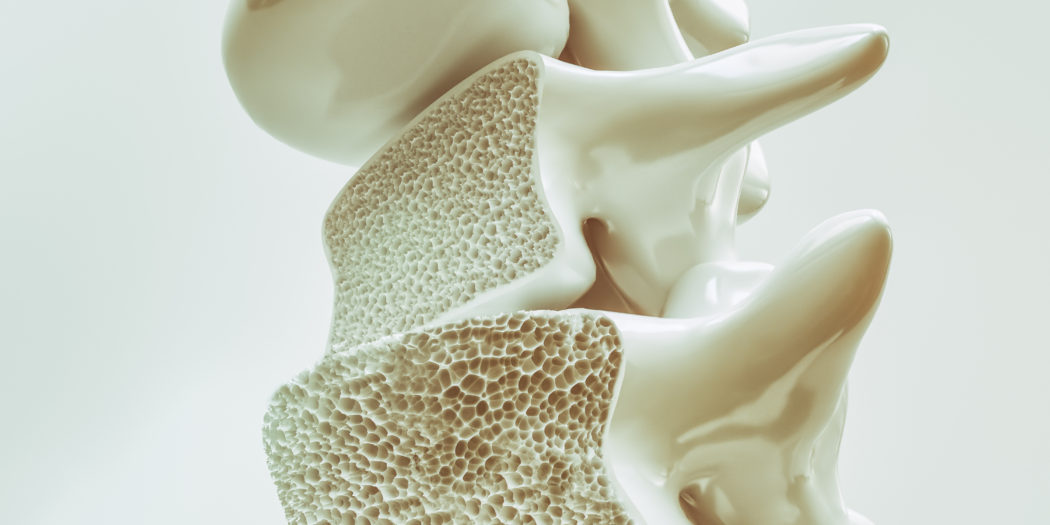 Osteoporosis osteoporoza kości