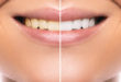 domowe sposoby na wybielanie zębów