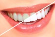 Efekt wybielania zębów metodą nakładkową w gabinecie stomatologii estetycznej